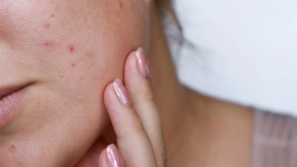 messages-of-pimples-saeeclinic
